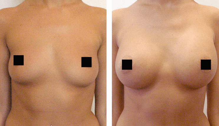 使用透明质酸隆胸前后的乳房