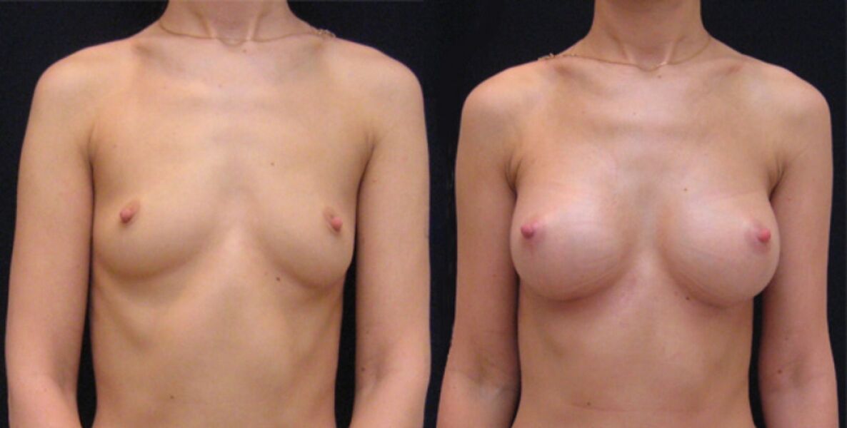 内窥镜隆胸前后的乳房