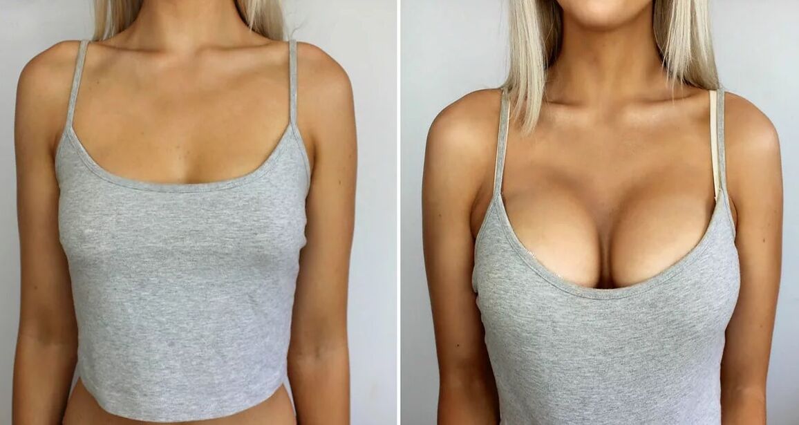乳房增大3尺寸