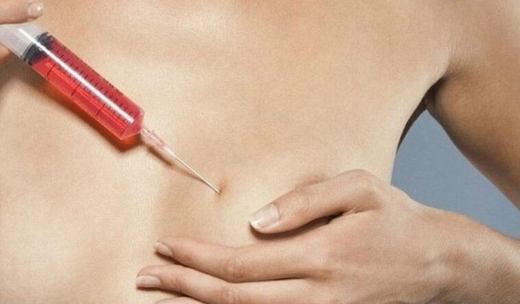 通过注射玻尿酸丰胸